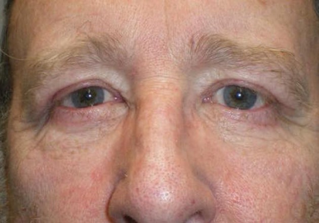 Upper/Lower Lid Blepharoplasty