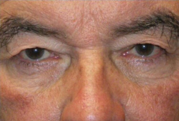 Upper/Lower Lid Blepharoplasty