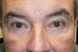 Upper/Lower Lid Blepharoplasty