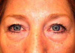 Upper Lid Blepharoplasty (upper eyelid lift)