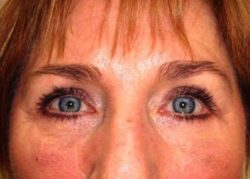 Upper Lid Blepharoplasty (upper eyelid lift)