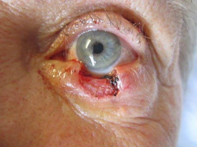 Lesion Removal Case 186 Before Photo Lesion Removal