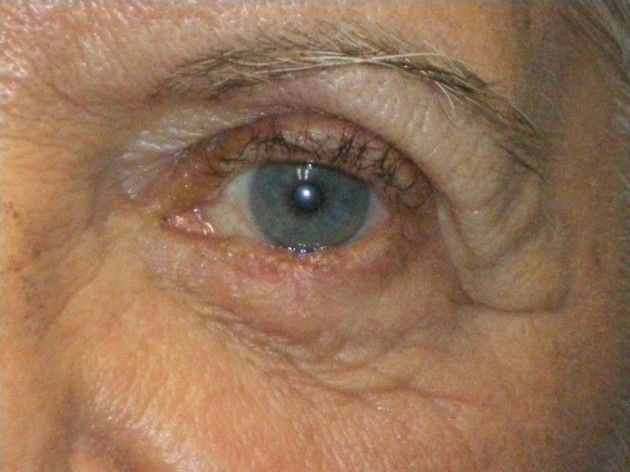 Lesion Removal Case 186 After Photo Lesion Removal
