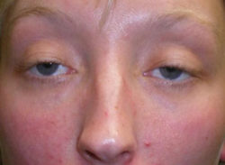Eyelid Lift (blepharoplasty/ptosis repair)