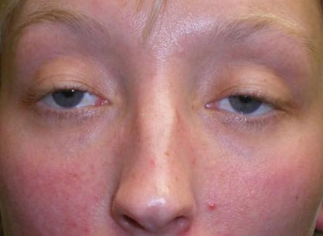 Eyelid Lift (blepharoplasty/ptosis repair) Case 210 Before Photo Eyelid Lift (blepharoplasty/ptosis repair)