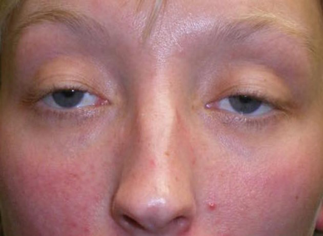 Ptosis Repair