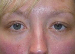 Eyelid Lift (blepharoplasty/ptosis repair)