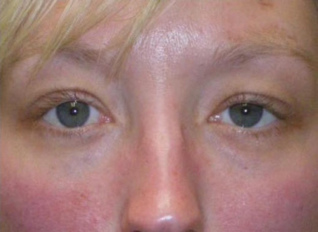 Eyelid Lift (blepharoplasty/ptosis repair) Case 210 After Photo Eyelid Lift (blepharoplasty/ptosis repair)