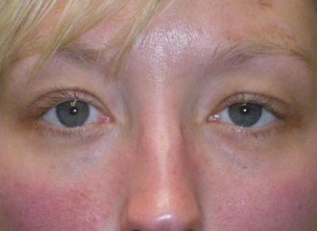 Ptosis Repair