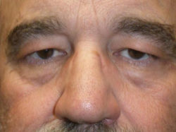 Eyelid Lift (blepharoplasty/ptosis repair)