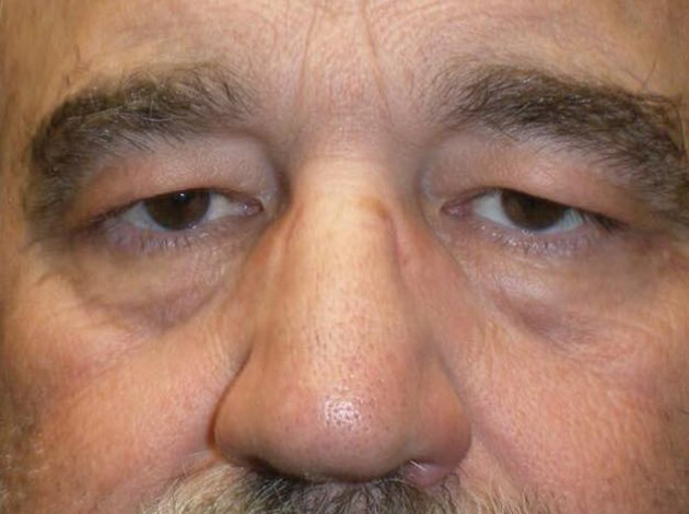 Eyelid Lift (blepharoplasty/ptosis repair)