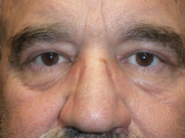 Eyelid Lift (blepharoplasty/ptosis repair)