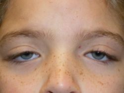 Eyelid Lift (blepharoplasty/ptosis repair)