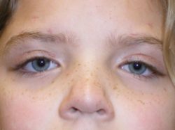 Eyelid Lift (blepharoplasty/ptosis repair)