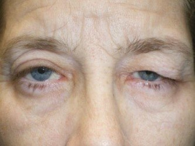 Eyelid Lift (blepharoplasty/ptosis repair)
