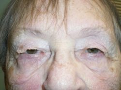 Eyelid Lift (blepharoplasty/ptosis repair)