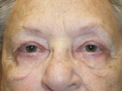 Eyelid Lift (blepharoplasty/ptosis repair)