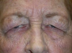 Eyelid Lift (blepharoplasty/ptosis repair)
