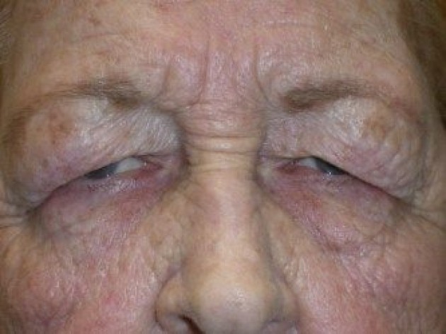 Eyelid Lift (blepharoplasty/ptosis repair)