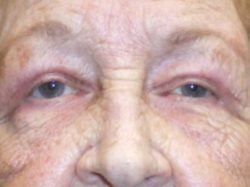 Eyelid Lift (blepharoplasty/ptosis repair)