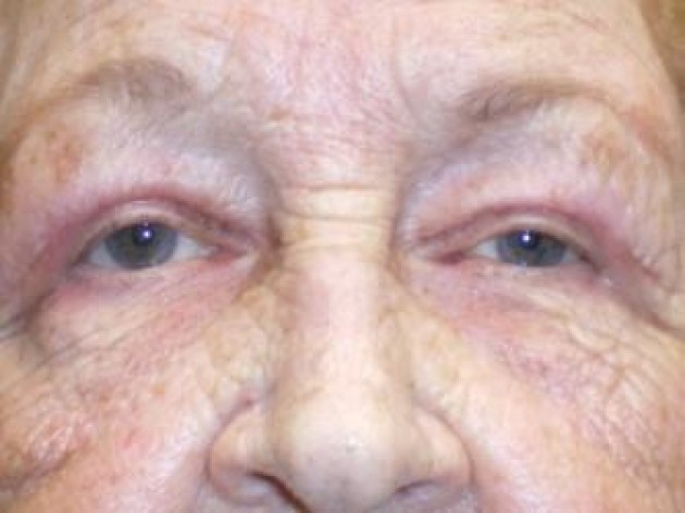 Eyelid Lift (blepharoplasty/ptosis repair)