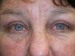 Eyelid Lift (blepharoplasty/ptosis repair)
