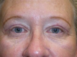 Eyelid Lift (Blepharoplasty/Ptosis Repair)