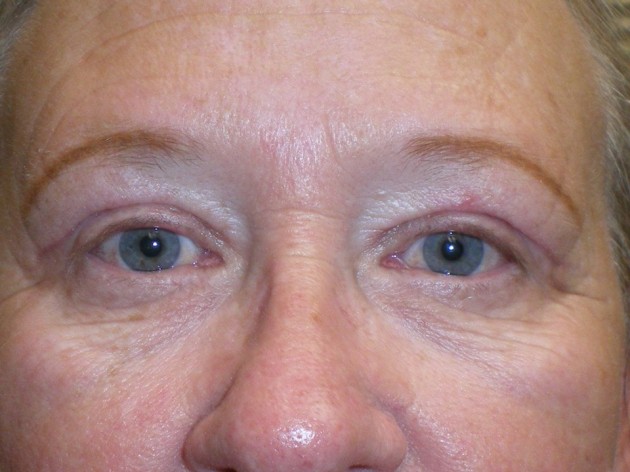 Eyelid Lift (Blepharoplasty/Ptosis Repair)