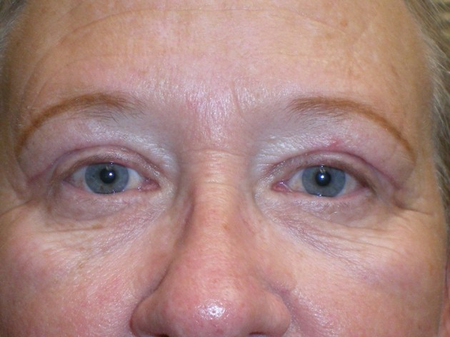 Eyelid Lift