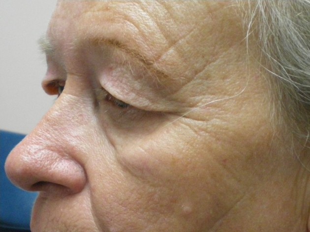 Eyelid Lift (Blepharoplasty/Ptosis Repair)