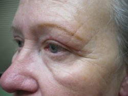Eyelid Lift (Blepharoplasty/Ptosis Repair)