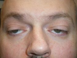 Eyelid Lift (blepharoplasty/ptosis repair)