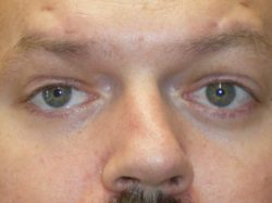 Eyelid Lift (blepharoplasty/ptosis repair)