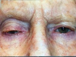 Eyelid Lift (blepharoplasty/ptosis repair)