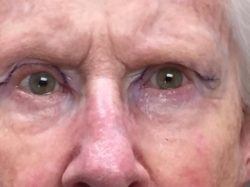 Eyelid Lift (blepharoplasty/ptosis repair)
