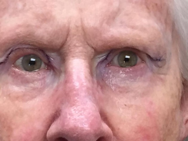 Eyelid Lift (blepharoplasty/ptosis repair)