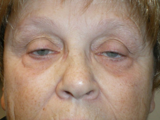 Eyelid Lift (blepharoplasty/ptosis repair)