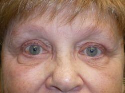 Eyelid Lift (blepharoplasty/ptosis repair)