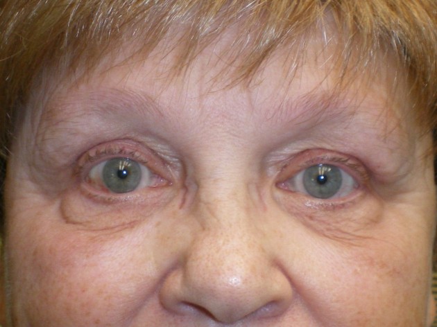 Eyelid Lift (blepharoplasty/ptosis repair)