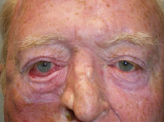 Ectropion, Entropion (Repair of Lower Lid Malposition) Case 264 Before Photo Ectropion, Entropion (Repair of Lower Lid Malposition)