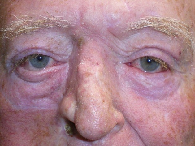 Ectropion, Entropion (Repair of Lower Lid Malposition) Case 264 After Photo Ectropion, Entropion (Repair of Lower Lid Malposition)