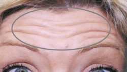 Botox (wrinkle reduction)