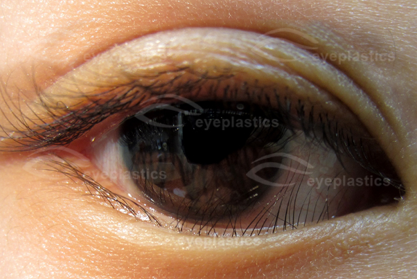 eyelid diseases