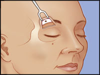 In-Direct Brow Lift 1 TransBlepfig2small