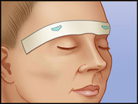 In-Direct Brow Lift 2 TransBlephfig7