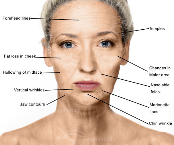Aging Face | mid face aging face | Facelift | Facelift