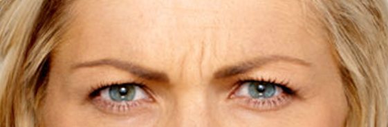 Botulinum Forehead Wrinkles Boise, ID