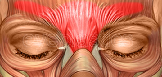Botox/Dysport - Forehead