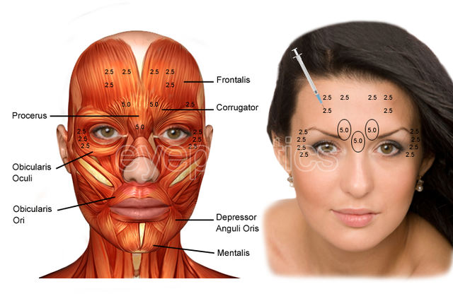 Botox/Dysport procedure