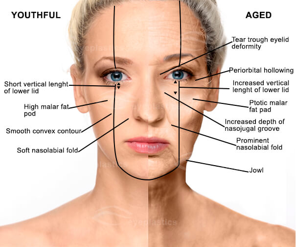 mid face aging face | Face lift | Facelift